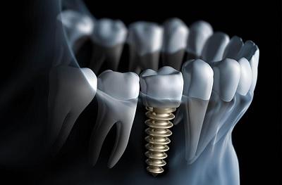 Dental Implants & Periodontal Health